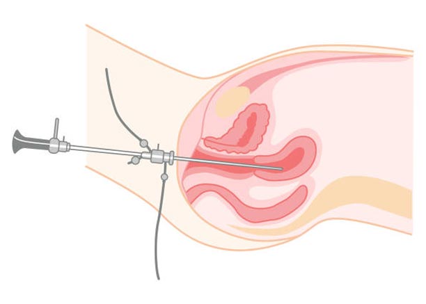 The Power of Hysteroscopy Explained Simply