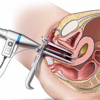 hysteroscopy in Vijayawada